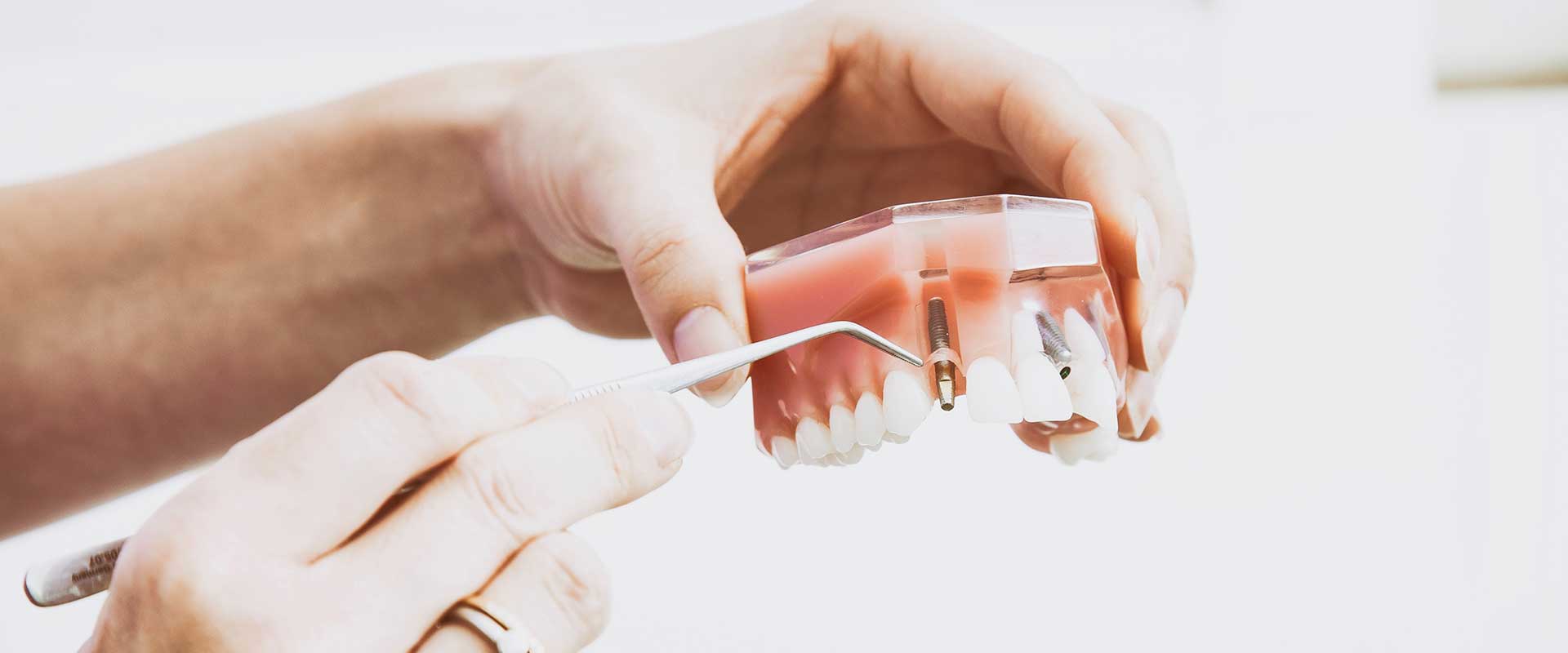 Dental Veneers | Dentist Downtown Calgary | Eau Claire Park Dental