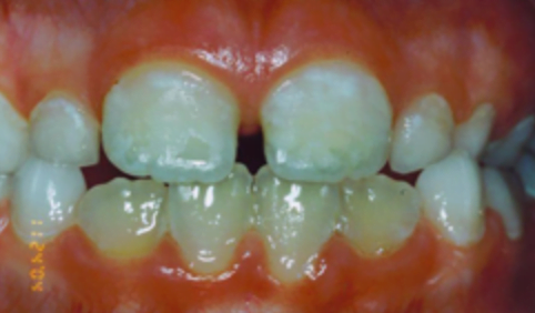 Patient's Teeth | Dentist Downtown Calgary | Eau Claire Park Dental