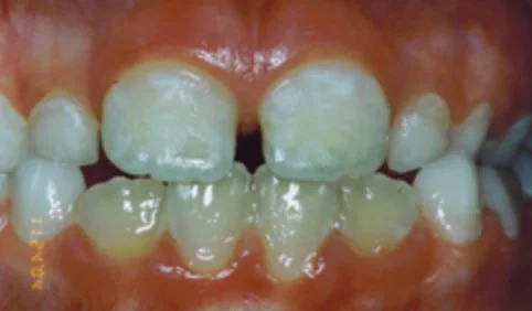 untreated celiac disease | Dentist Downtown Calgary | Eau Claire Park Dental