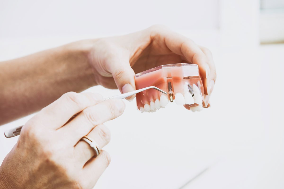 different types of dental crowns | Dentist Downtown Calgary | Eau Claire Park Dental