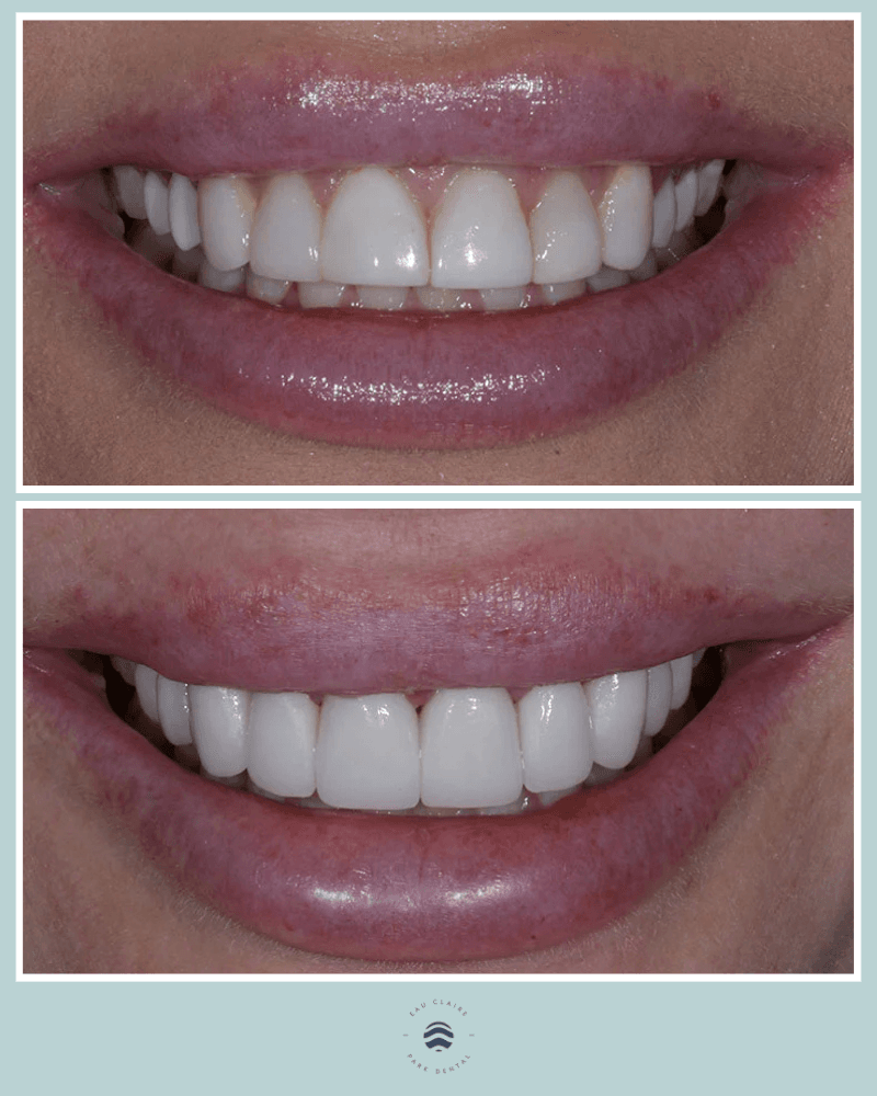 image3 Before and after replacing composite bonding with porcelain veneers, Dr. Jennifer Graas, Calgary cosmetic dentist