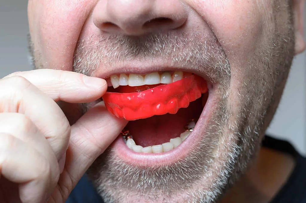 How does a mouthguard protect your teeth | Dentist Downtown Calgary | Eau Claire Park Dental