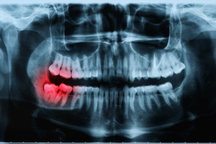 Teeth X-Ray | Dentist Downtown Calgary | Eau Claire Park Dental