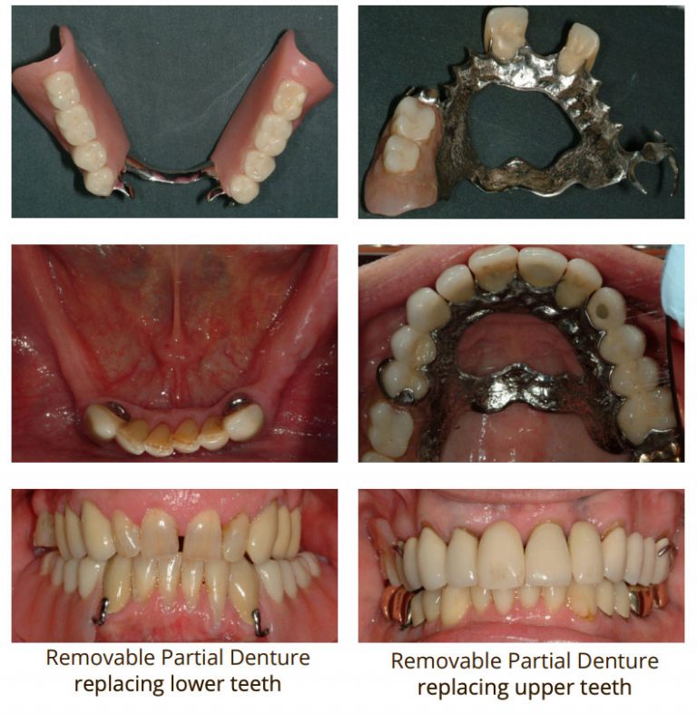 Dental Implants Vs Partial Dentures Eau Claire Park Dental 
