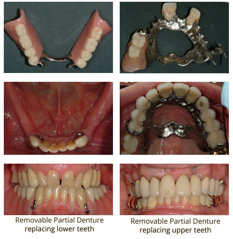 dental implants vs partial dentures