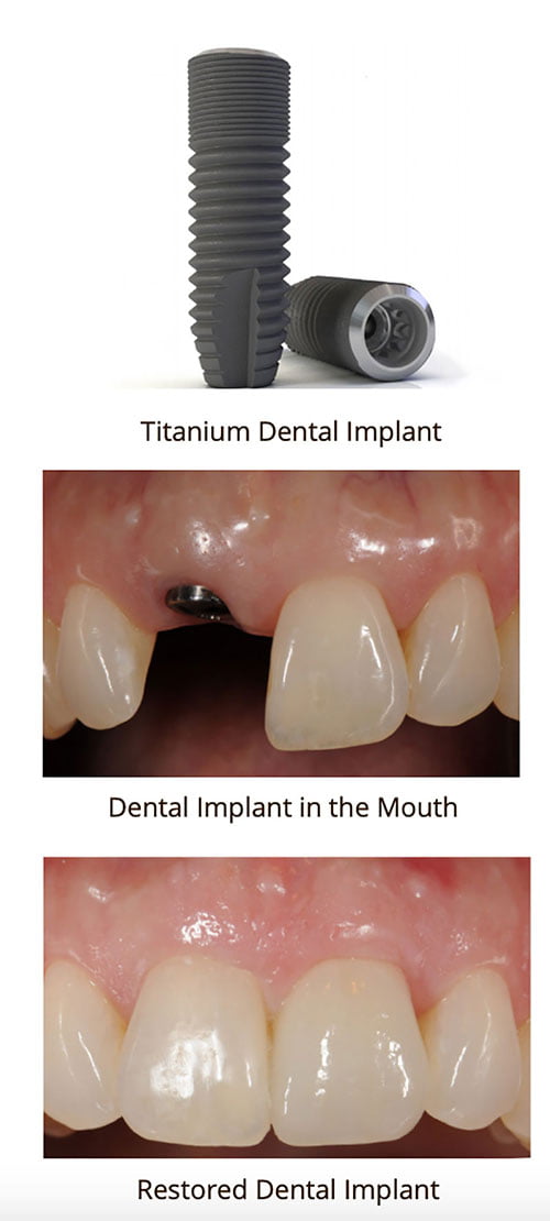 dental implants vs partial dentures