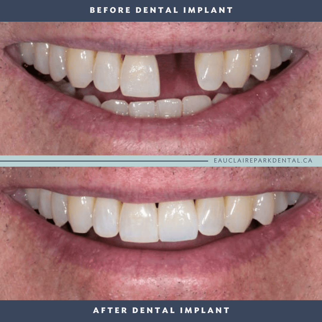This patient received a dental implant to restore his front tooth, achieving a natural-looking and confident smile.