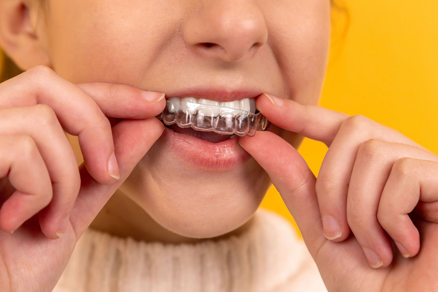 Cleaning Your Braces and Teeth Properly