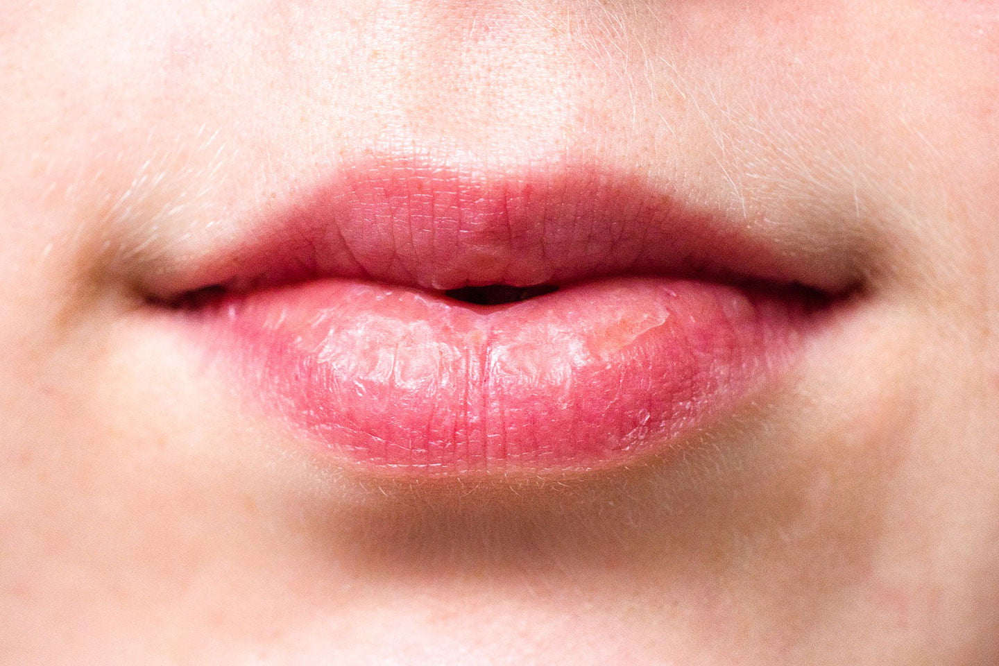 Causes of Dry Mouth | Xerostomia