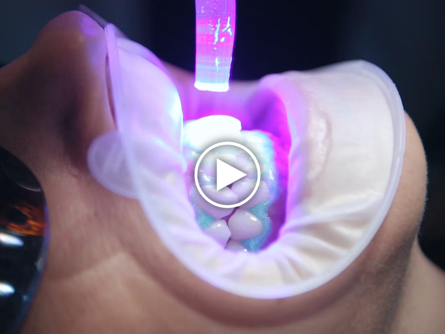 Guided Biofilm Therapy