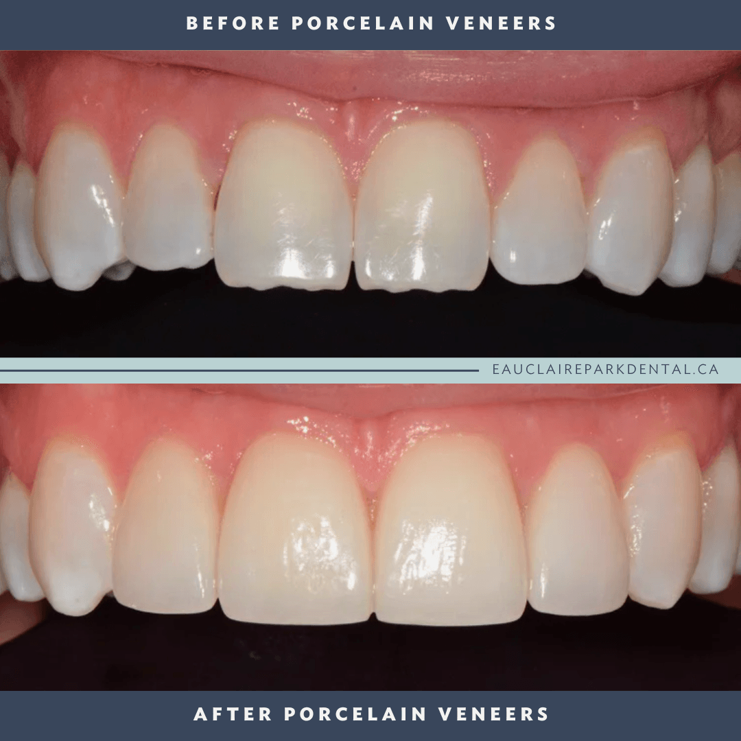 before-after-venners