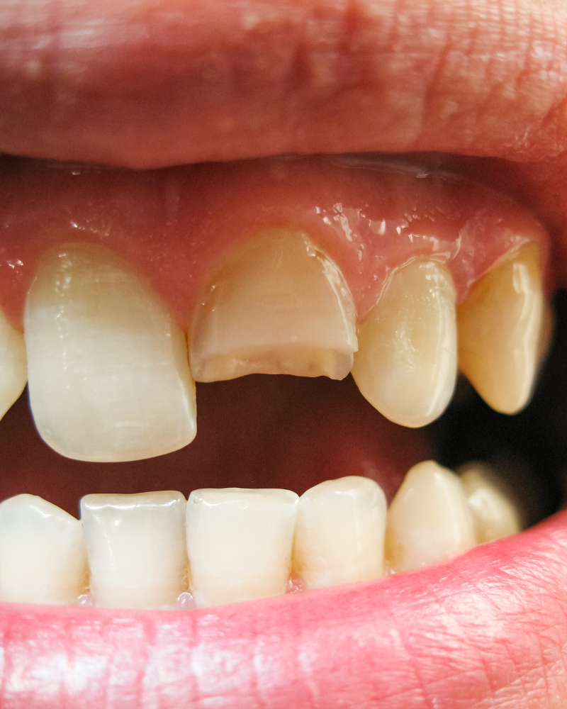 Close-up of a chipped adult front tooth showing when to call an emergency dentist in Calgary.