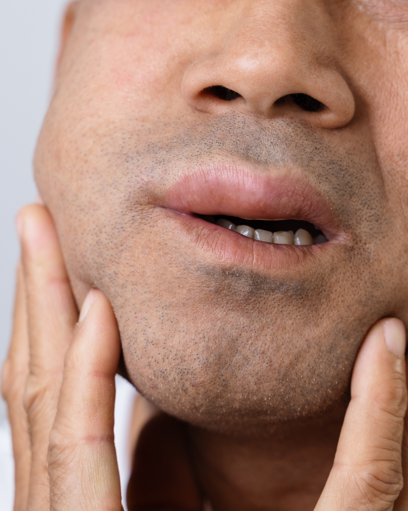 Facial swelling from dental abscess showing signs of a dental emergency.