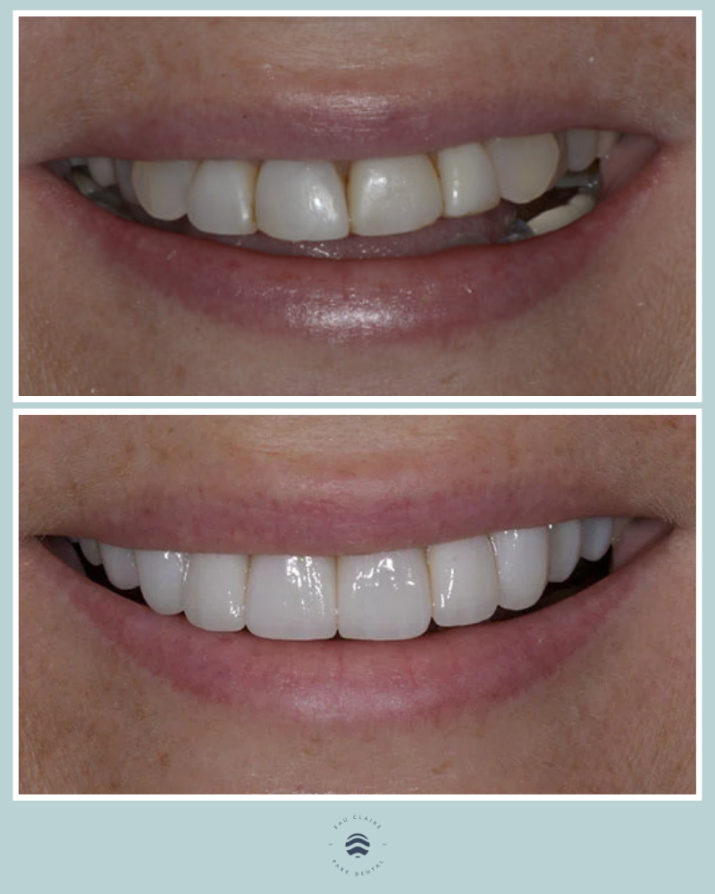 Before and after replacing composite bonding with porcelain veneers, Dr. Jennifer Graas, Calgary cosmetic dentist.