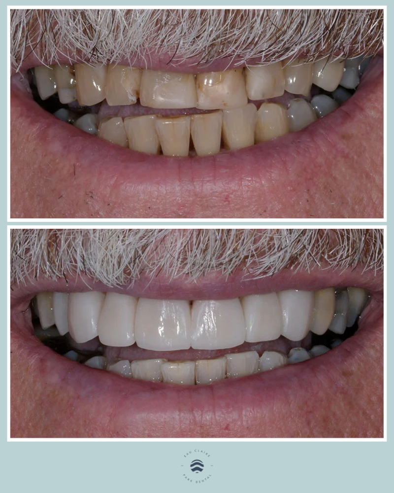Before and after replacing old composite bonding with new composite veneers, Dr. Jennifer Graas, Calgary cosmetic dentist.