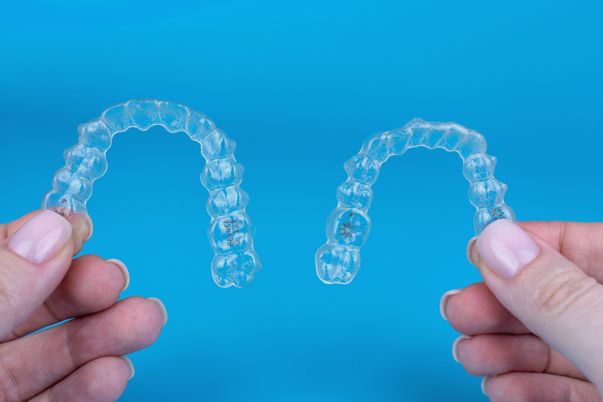 ? Orthodontic treatment for underbite correction isn’t one-size-fits-all. The right approach depends entirely on the specific mechanics of your jaw and teeth. Invisalign can successfully fix many underbites, particularly those caused by the angle of your teeth rather than the underlying bone structure. Clear aligners have evolved significantly over the last few decades. Dentists now use them to shift lower teeth back and upper teeth forward. This corrects the reverse overlap characteristic of an underbite. However, whether you’ll be a good candidate for the treatment depends on a thorough functional diagnosis. The goal is to map out exactly how your jaws and teeth interact so we can find appropriate solutions. Evaluating Your Candidacy for Clear Aligners Although underbites are common, affecting 5 to 10% of all people, not every underbite behaves the same way. An underbite occurs when your lower front teeth sit ahead of your upper front teeth. The misalignment creates a unique set of functional challenges, ranging from premature tooth wear to chewing difficulties and jaw joint stress. To decide if clear aligners will work for you, we need to look past the visible position of your teeth. We evaluate the relationship between your upper and lower jaws. We also examine the health of your temporomandibular joint (TMJ) and the specific angles of your incisors. This is how we determine whether orthodontic treatment for underbite is the right path forward for you. Mild to Moderate Underbites If your underbite stems primarily from how your teeth tilt or crowd within the dental arch, you may be a strong candidate for clear aligner therapy. Dentists refer to this as a "dental underbite," in which the underlying jawbone aligns properly but the teeth have erupted at an unfavourable angle. Invisalign works here because it applies constant, controlled force to tilt those misaligned teeth back into their correct positions. The aligners push the upper teeth forward and the lower teeth backward. The gradual shift eliminates the reverse overlap, establishing a stable, functional bite. The plastic trays wrap around the entire arch, providing a stable anchor point to orchestrate these simultaneous movements. Severe Skeletal Underbites A skeletal underbite has a different structure and, therefore, an entirely different situation for Invisalign candidacy. In these cases, the lower jawbone has grown significantly further forward than the upper jawbone. The discrepancy exists in the bone structure, rather than just the position of the teeth. Clear aligners alone can’t physically shorten or reposition the jawbone. Treating a severe skeletal underbite would likely require surgical intervention to reposition the jaws. This would be paired with traditional braces or aligners to finalize the tooth placement. Invisalign isn’t usually recommended here as a first-line approach. Attempting to mask a severe skeletal discrepancy by heavily tipping the teeth with aligners often leads to unstable bites, recession and compromised tooth roots. How We Approach Orthodontic Treatment for Underbite The process of successfully correcting a bite starts long before you ever wear your first set of aligners. Dr. Graas approaches this through the lens of her Kois Center training. The curriculum focuses heavily on occlusion, which is how your teeth fit and function together, along with comprehensive risk assessment. We recognize that bite issues rarely exist in isolation. An underbite often contributes to accelerated enamel wear, chipping, and muscle tension in your face and neck. A functional diagnosis maps out exactly how your teeth currently meet. It also considers how they should meet to distribute chewing forces evenly. Teeth meant for biting shouldn’t be carrying the heavy loads meant for chewing. Dr. Graas uses the information from your functional diagnosis to map out your treatment, step by step. She analyzes the precise sequence of tooth movements required to fix the underbite without creating new interferences. This thorough evaluation determines the entire treatment plan up front. It gives you a clear picture of the required time and mechanics. She can assess the thickness of your gum tissue, the density of your bone, and the specific wear patterns on your enamel. Then, we can build a treatment plan that supports your total oral health. The Mechanics of Orthodontic Treatment for an Underbite Shifting an underbite involves more than just wearing the plastic trays. Complex bite corrections often require auxiliary tools to help the aligners achieve the necessary force and direction. You would need composite attachments placed on specific teeth. These small, tooth-coloured bumps give the aligners leverage to grip the teeth and apply directional pressure. Acting as microscopic handles, they allow the plastic trays to rotate. They translate teeth in ways that smooth plastic alone just can’t achieve. Underbite correction almost always requires orthodontic elastics (rubber bands). You attach these elastics to small hooks cut into the alignments or to metal buttons bonded directly to your back teeth. The bands stretch from the lower jaw to the upper jaw, applying continuous tension that pulls the lower arch back and the upper arch forward. Whether you wear your elastics exactly as prescribed ultimately determines the success of this bite correction. The aligners position the teeth within the bone, while the elastics establish the relationship between the upper and lower arches. Timeline and Daily Expectations Correcting functional bite issues takes time. While minor aesthetic alignments might wrap up in six months, structural bite correction generally spans 12 to 24 months. The exact timeline depends on the severity of the initial misalignment and your compliance with wearing the aligners. You need to wear your aligners for 20 to 22 hours every day, removing them only to eat, drink anything other than plain water, brush, and floss. If you fall short of this daily target, it slows down tooth movement and can prevent the aligners from tracking properly. When the aligners stop tracking, the plastic loses its grip on the attachments, and the teeth stop moving according to the digital plan. Expect each new set of aligners to feel tight for the first few days. This pressure confirms the trays are actively working. As your teeth adjust to the new position, the pressure subsides until you swap to the next tray in the series. Again, consistency is important, as wearing the aligners diligently keeps the inflammatory process active and allows the bone to continuously remodel around the moving roots. Maintaining strict oral hygiene is equally important during this period. Because the trays trap saliva against your teeth, they also trap any sugars or food debris left behind after eating. Brushing and flossing after every meal prevents the aligners from becoming an incubator for decay. Exploring Alternative Orthodontic Options Clear aligners handle complex tooth movements beautifully, but certain mechanical challenges are better addressed with traditional bracket-and-wire systems. Traditional braces offer maximum control over root angulation and vertical tooth movements. If a tooth needs to be pulled down from the gums or rotated severely, the fixed grip of a metal or ceramic bracket provides superior leverage. Dr. Graas evaluates the mechanical demands of your specific bite and will recommend traditional braces if they offer a more predictable, stable result for your dental anatomy. We prioritize long-term stability and joint health over any single treatment modality. The goal is always a functional, comfortable bite that protects your teeth from premature wear and joint strain.