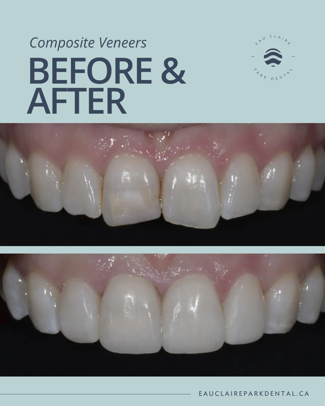 f2EtAFwe Before and after results showcasing composite veneers by Dr. Jennifer Graas at Eau Claire Park Dental in Calgary, Alberta