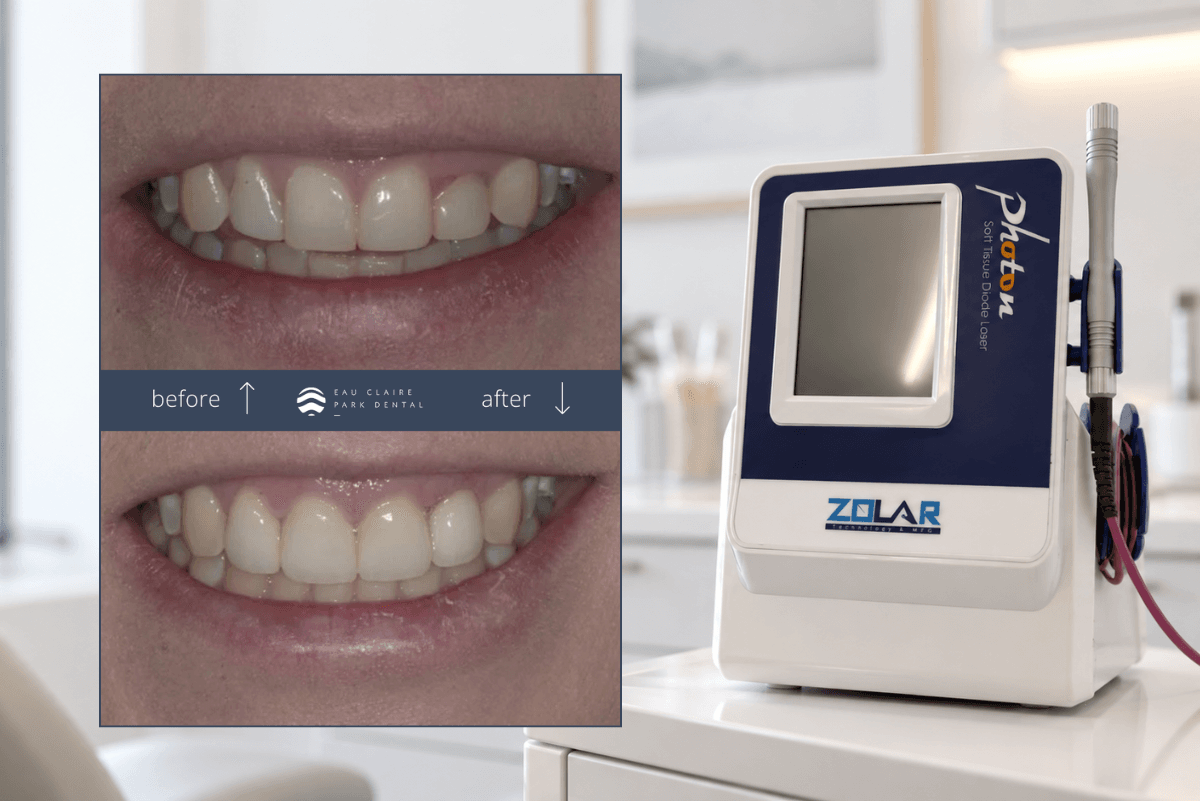 Before and after gum contouring with veneers, alongside the laser used at Eau Claire Park Dental